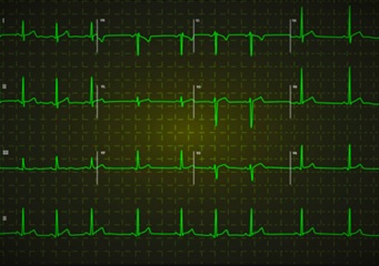 ecg.jpg